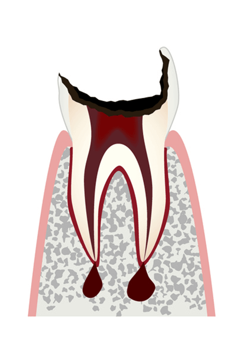 C4 歯根まで進行したむし歯